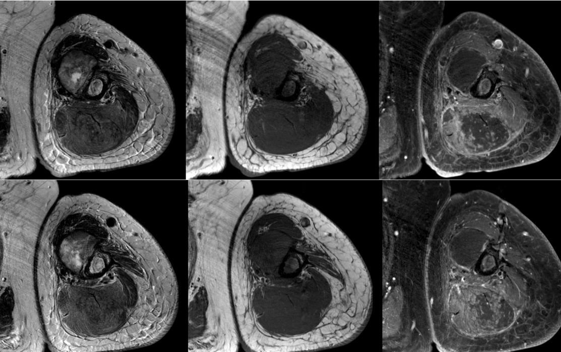 Figure 2 for case Radiation induced myonecrosis